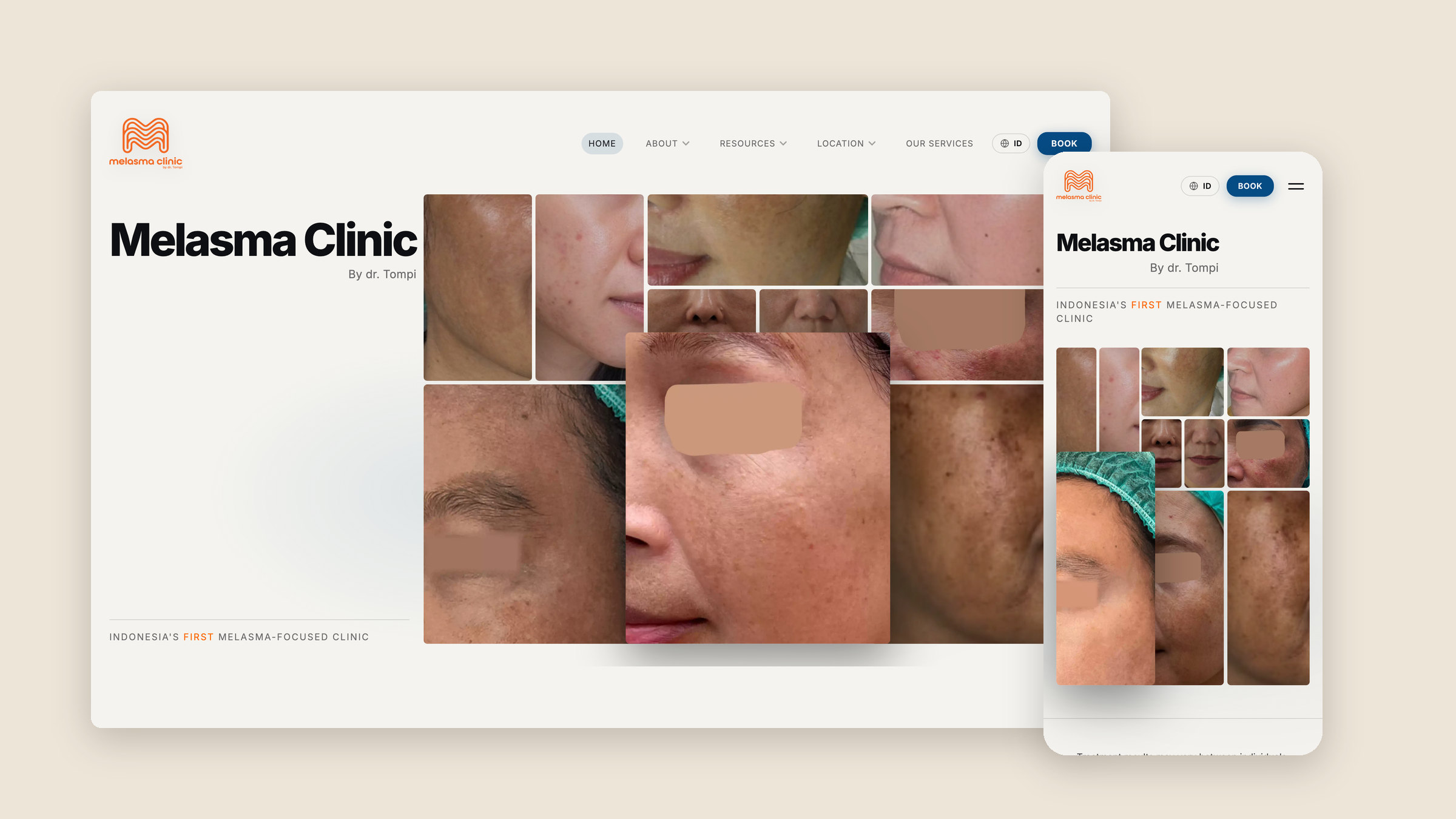 The Melasma Clinic by Dr. Tompi homepage on desktop and on a phone, led by a grid of patient before-and-after photos